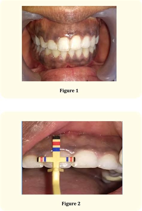 Gingival Hyperplasia Braces