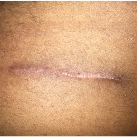 Mcburneys Point Appendicectomy Scar Download Scientific Diagram