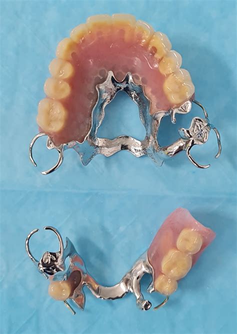 Implant Dentures (Partial) - Northland Prosthodontics - Northland Denture Specialist - Whangarei