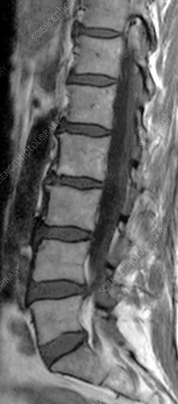 Spondylolysis Mri