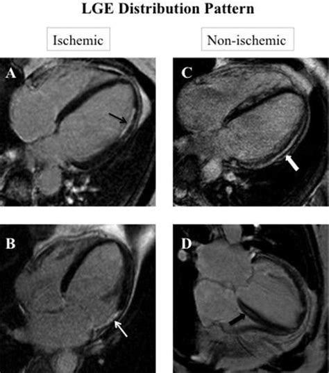 Figure 1 From Cardiac Mri Anatomy And Function As A Substrate For Arrhythmias Semantic Scholar