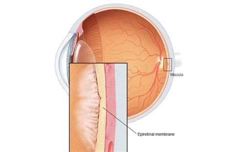 Epiretinal Membrane | Asia Retina Singapore