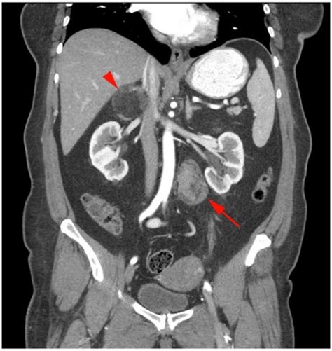 Coronal Image From Contrast Enhanced CT Of The Abdomen Open I