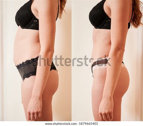 Side View Of Woman S Body Before And After Weight Loss Plastic Surgery