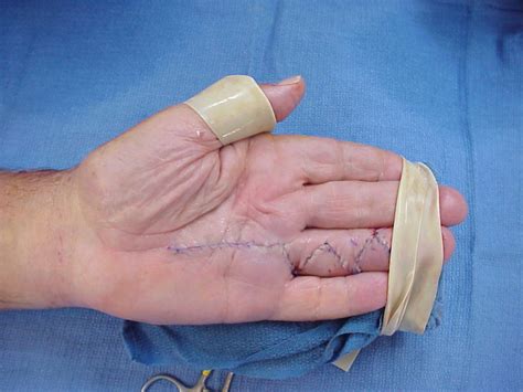 Dupuytren S Palmar Fasciectomy And Removal Foreign Body