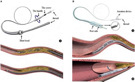 Frontiers A Clinical Analysis Of The Treatment Of Chronic Coronary