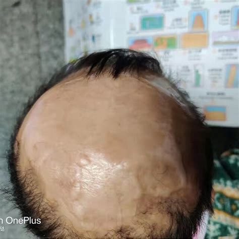 The Scalp Of The Patient With Aplasia Cutis Congenita At Years Old