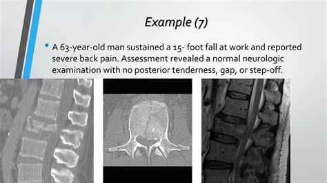 Thoracolumbar Fractures Classification Ppt