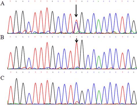 Partial Sequence Chromatograms Of DUOX2 A The Missense Heterozygous