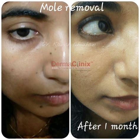 Wart Treatment Before After Results, Mole Removal Patient Photos Delhi