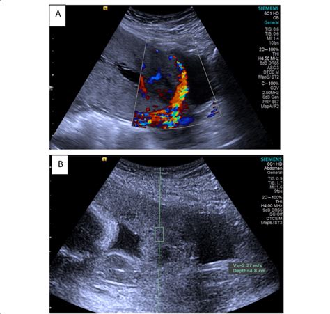 Pregnancy With Placenta Preavia And Accreta Gestational Age 27 Weeks