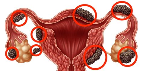 Endometriosis - TeraEbonnie