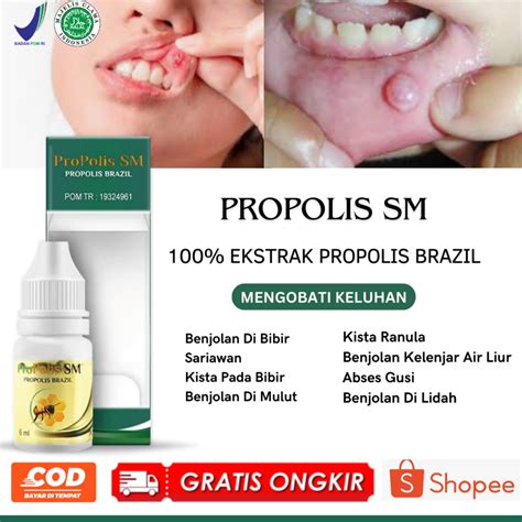 Jual Obat Sariawan Kista Pada Bibir Benjolan Di Mulut Abses Gusi Anak And Dewasa Benjolan Kelenjar