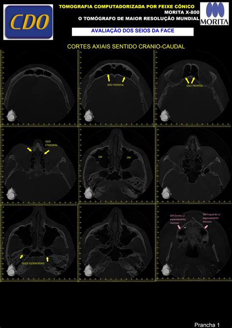 Tomografia Computadorizada De Alta Resolu O Cdo Radiografias