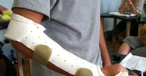 Munster Splint Prevents Forearm Rotation Often Used For Protection Of