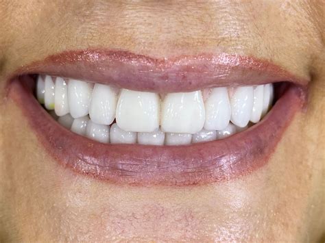 Smile Gallery Before And After Dentures In Surrey Bc