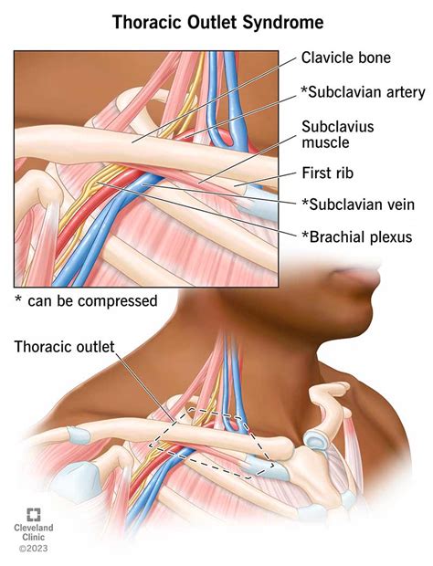 Thoracic Outlet Syndrome (Diagnosis Tests Stretches, 60% OFF