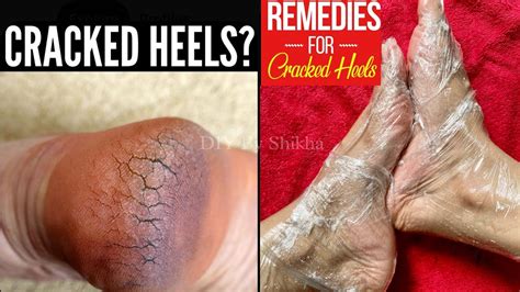 Fix Dry Cracked Heels How To Repair Cracked Heels At Home Treatment