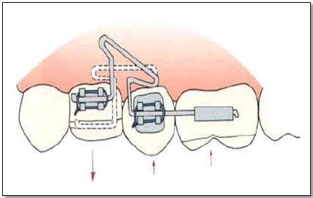 Segmental T-loop in a rectangular wire 4 | Download Scientific Diagram