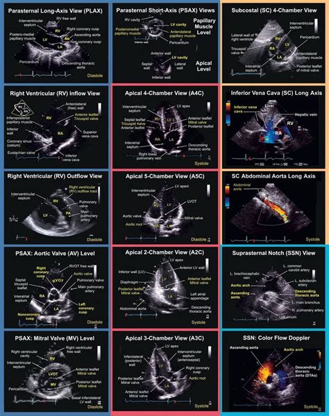 587 best 12 Lead EKG images on Pinterest | Nursing schools, Schools for nursing and Nursing students