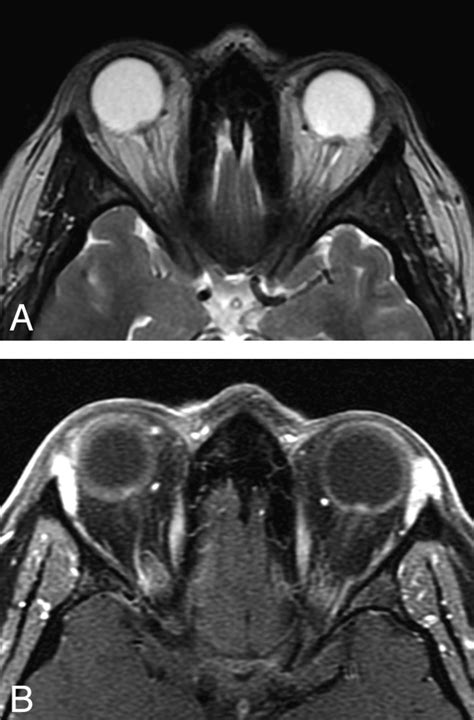 Papilledema Mri