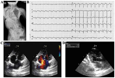 Percutaneous Closure Of A Large Atrial Septal Defect In A Child With