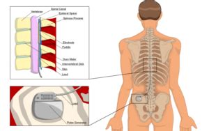 Spinal Cord Stimulator Pain Management Clinics In Las Vegas Nevada