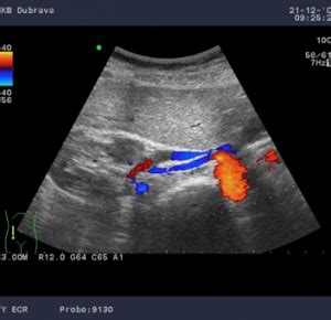 (Ch:41) Ultrasound of the renal vessels – EFSUMB