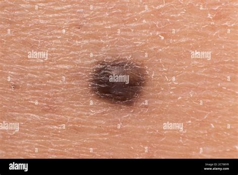 Mole Birthmark Nevus Macro Photo On Human Skin Close Up Stock Photo