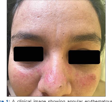 Figure 1 From Subacute Cutaneous Lupus Erythematosus Induced By