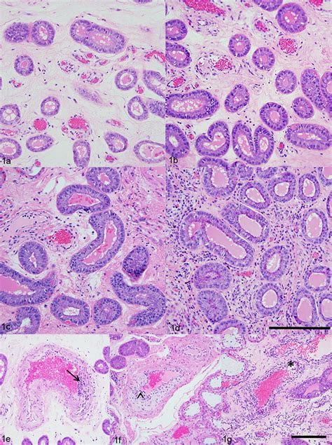 Histologic Scores Of Endometrial Inflammation And Severity Of