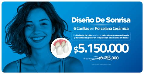 Qué son las Carillas Dentales para qué sirven y cuándo son