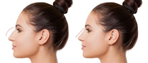 Rhinoplastie Tunisie Combien Co Te Une Rhinoplastie