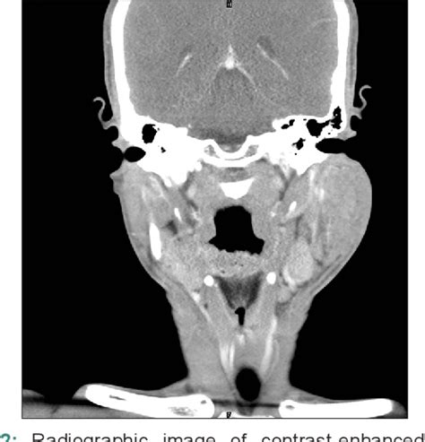 Figure 2 From Kimuras Disease An Unusual Presentation Involving