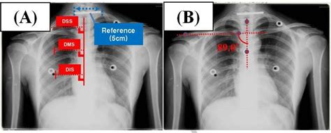 Figure 3 from Effects of scapular upward rotation exercises on ...