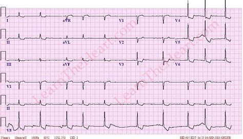 DIgoxin Effect ECG Example 1 LearntheHeart