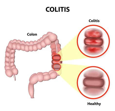 pediatrics ulcerative colitis  content library