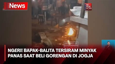 Balita Asal Yogyakarta Tersiram Minyak Panas Hingga Alami Luka Bakar 64