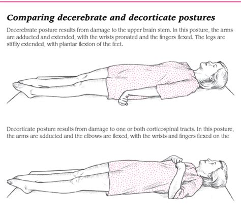 Decerebrate vs decorticate postures How I remember: DecErEbrate ...