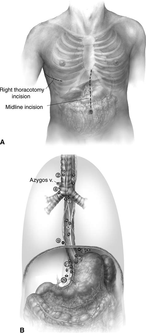 Technique Of Open Ivor Lewis Esophagectomy Operative Techniques In