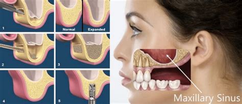 Dentistry Implantology Current Techniques Seychelles Nation