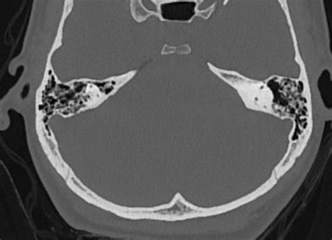 Radiopaedia Case External Auditory Canal Cholesteatoma Id Study