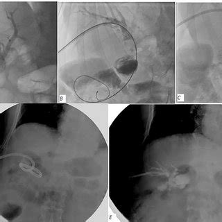 A Case Cholangiogram Showing A Large Filling Defect In The Common