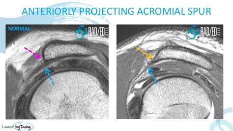 Acromion Types Radiology