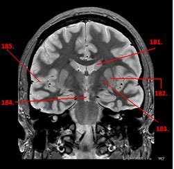 Brain Sectional Anatomy Diagram Quizlet