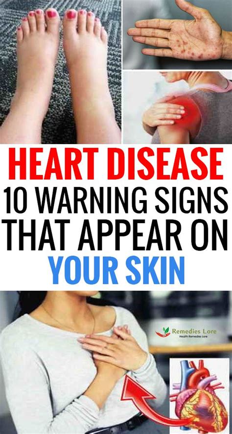 Heart Disease 10 Warning Signs That Appear On Your Skin Heart