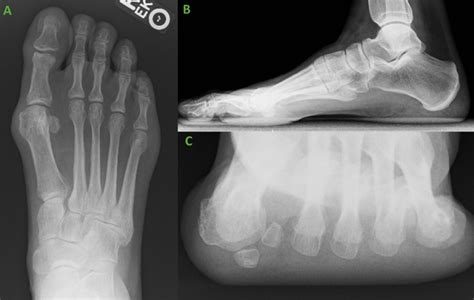 OSSIOfiber® Compression Screw Fixation for Intercuneiform Instability ...