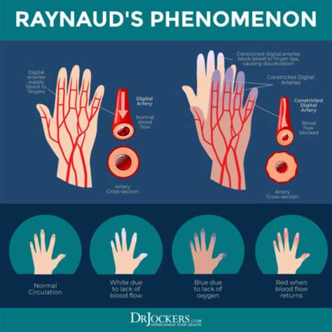 Raynaud's Phenomenon: Causes, Symptoms & Support Strategies