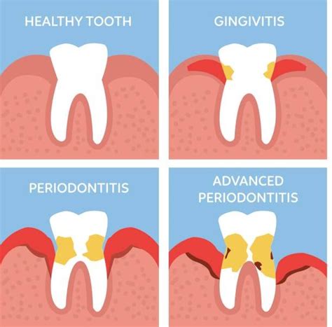 Stages Of Tooth Periodontitis Dental Anatomy Concept Vector