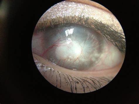 Corneal neovascularization and scarring due to over wearing contact ...